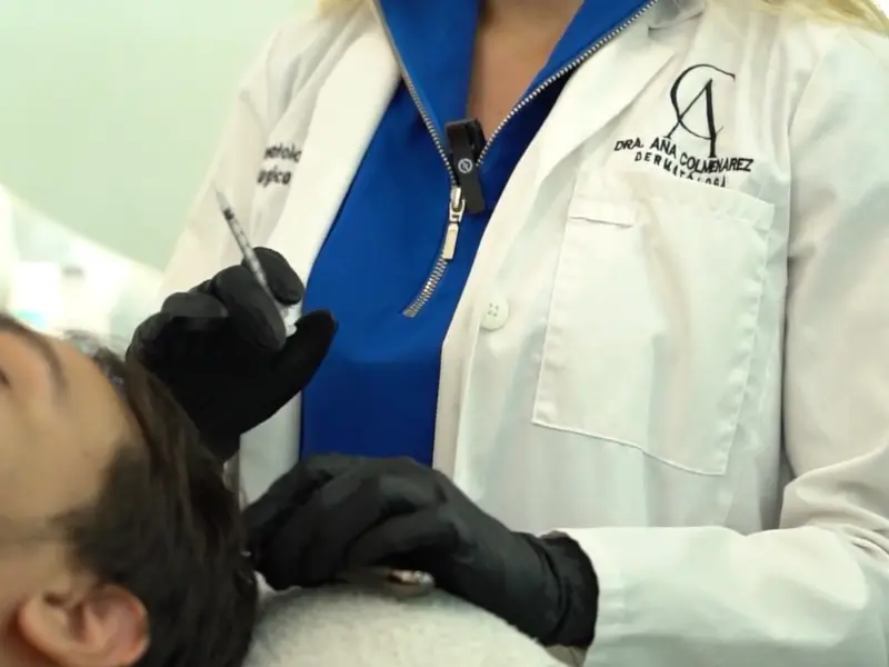 Mesoterapia Capilar